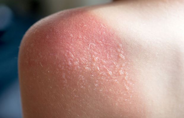 tránh để cháy nắng trước khi thực hiện massage nuru tránh để cháy nắng trước khi thực hiện massage nuru