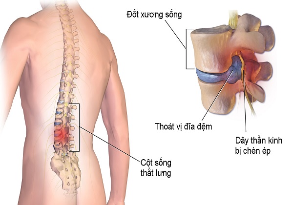 Cách mát xa lưng cho người thoát vị đĩa đệm và những điều cần lưu ý Cách massage lưng cho người thoát vị đĩa đệm được quan tâm
